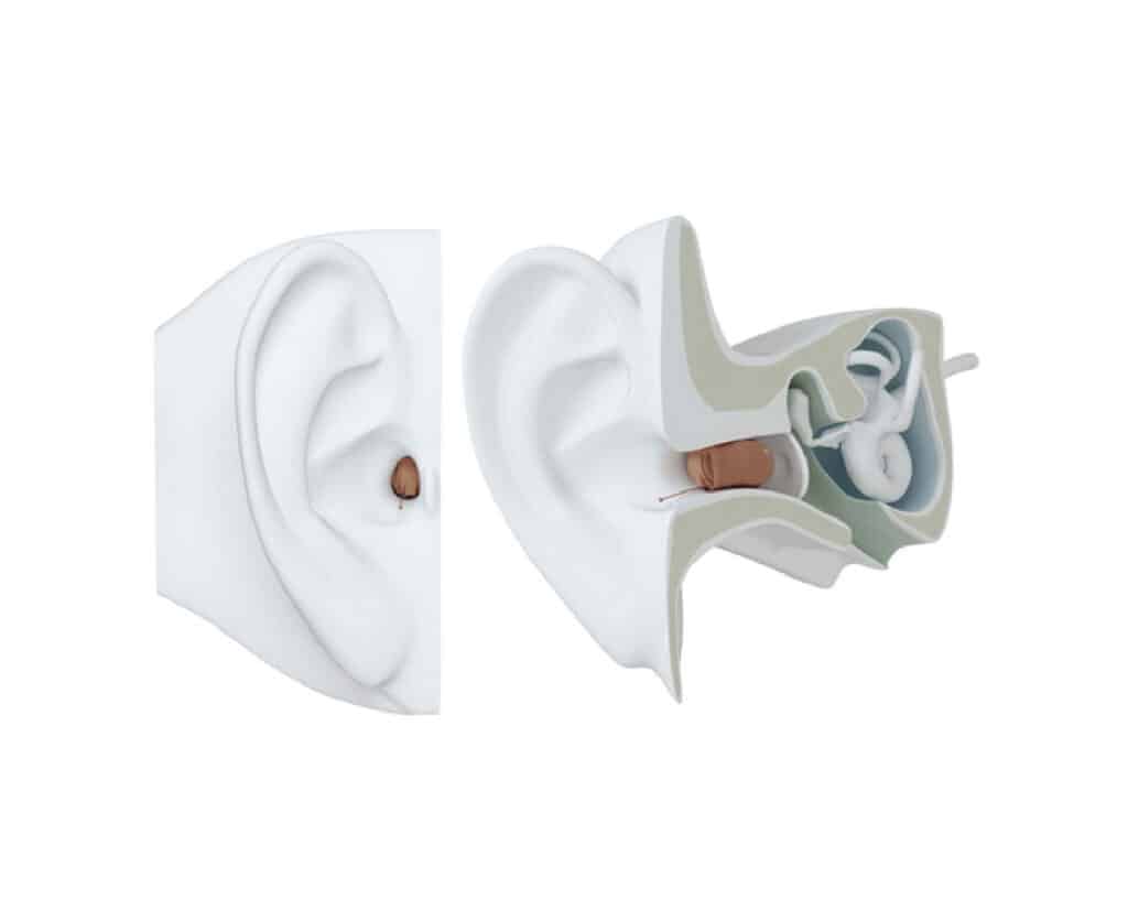 IIC hearing aids